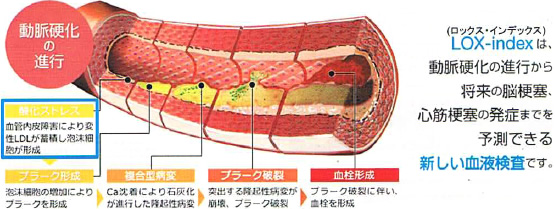 動脈硬化の進行段階を示す図